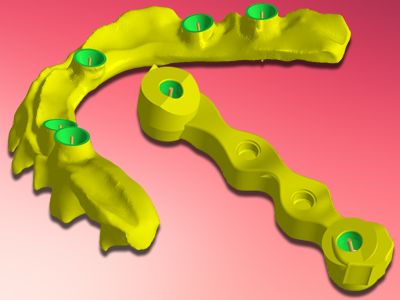 Barres d'implant et bridges